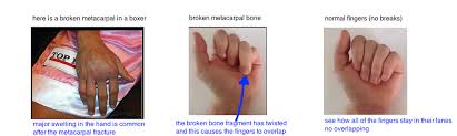 Broken Hand Metacarpal Fracture Bone Talks
