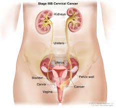 It will keep you from. Ovarian Cancer Possible After Hysterectomy Healthinfi