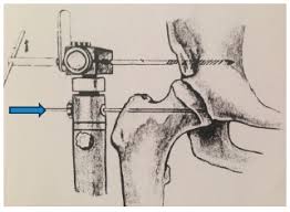 Scielo Brasil Initial Experience Of Use Of An Articulated External Fixator In Treating Legg Calve Perthes Disease By Means Of Arthrodiastasis During The Active Phase Of The Disease Initial Experience Of Use