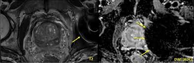 Prostate cancer staging is based on biopsy results including the gleason score, psa levels and other exams. Role Of Mri For The Detection Of Prostate Cancer Springerlink