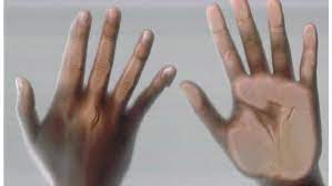 Los Mejores Remedios Para Tratar Los Hongos En Los Dedos De Las Manos