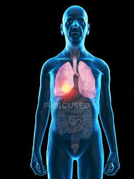 Welcome to the human anatomy and physiology page. Digital Illustration Of Senior Man Anatomy Showing Lung Tumour Human Anatomy Science Stock Photo 331048350