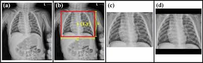 Diagnosis Of Common Pulmonary Diseases In Children By X Ray Images And Deep Learning Scientific Reports