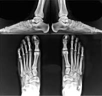 The role of arthroereisis of the subtalar joint for flatfoot ...