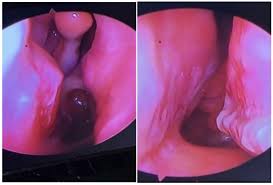 Image result for Nasal Packing