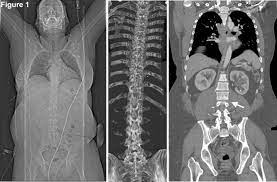 Isolated Multiple Lumbar Transverse Process Fractures With Spinal Instability An Uncommon Yet Serious Association Springerlink