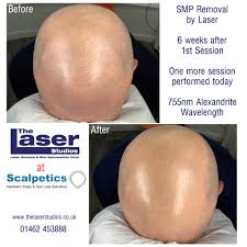 You're thinking of trying home laser hair removal? Scalpetics Posts Facebook