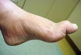 It commonly occurs in people whose feet have become very sweaty while confined within tightfitting shoes. 19 Common Foot Disorders