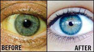 How To Whiten The Whites Of Your Eyes Naturally Get Rid Of Dull Yellow Eyes Sparkling White Eyes Youtube