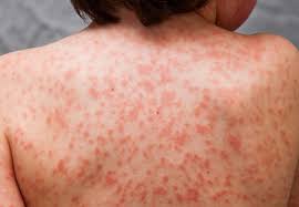 Researcher Kawasaki Disease Spike In San Diego Likely Tied To Aerosol Particles Kpbs