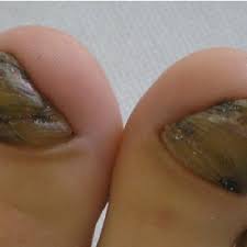 We propose to consider how to treat fungus of the toenails which professional preparations (tablets musty white or yellow under the nail, depending on the species of fungus, it can be bright, dull, with defined edges and muddy structure. Green Coloration Of The Toe Nail Download Scientific Diagram