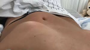 Endometriose ist eine erkrankung mit unterschiedlichen symptomen, bei der gewebe außerhalb der gebärmutter wuchert und nicht abgestoßen werden kann. Frau Mit Endometriose Zeigt Sich Nackt Und Hat Traurige Botschaft Gesundheit