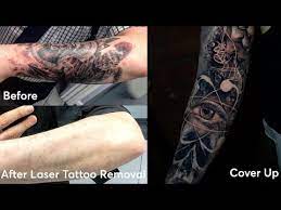 Whether you want to remove or cover your tattoo is down to personal preference. Tattoo Removal Cover Ups London Pulse Light Clinic London