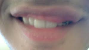 Wenn deine lippe durch eine verletzung geschwollen ist, wird sie während des heilungsprozesses für infektionen anfällig sein. Oberlippe Richtig Krass Angeschwollen Nach Op Tiefe Lippenbiopsie Schwillt Das Wieder Ab Bild Haut Schwellung Heilung