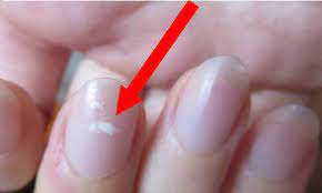 Manchas blancas en las uñas. Si Te Salen Manchas Blancas En Las Unas Puedes Sufrir De Estas Enfermedades