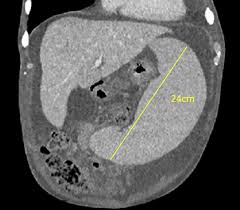 Image result for Splenomegaly