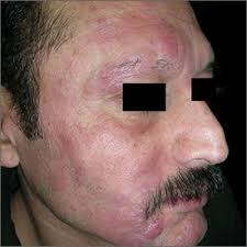 Sudden, unexplained weight loss of 10 percent or more of your body weight may be a sign of lymphoma. Rash With Hair Loss Mdedge Family Medicine