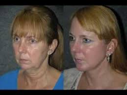 Facelift and Neck Lift Before and After Top NYC Plastic Surgeon Doctor  Andrew Jacono #facelift