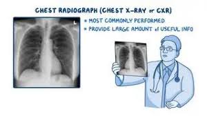 Image result for Chest XRay Interpretation