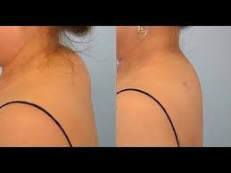 как избавиться от горба на спине в домашних условиях Takoe Bezobrazie Ni K Chemu Vot Kak Mne Udalos Izbavitsya Ot Uzhasnogo Vdovego Gorbika Na Shee Golbis Zdorove Uprazhneniya Uprazhneniya Dlya Spiny