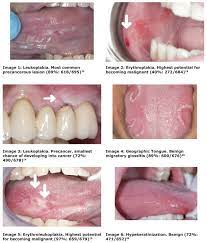 Does he like his job? Detection Of Early Stage Oral Cancer Lesions A Survey Of California Dental Hygienists Journal Of Dental Hygiene