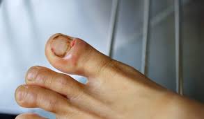 Naroa en comment soigner un ongle dorteil incarné. Du Sel Pour Soigner Les Ongles Incarnes Page 9