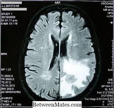Dengan terjadinya kehamilan menandakan bahwa pasangan suami isteri memiliki tingkat. Perbezaan Antara Tumor Otak Dan Kanser Otak Perbezaan Antara Pengambilan Pet Tumor Otak 2021 Yang Lain