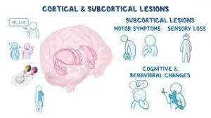 Image result for Cerebral Subcortex