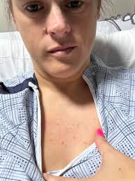 I've been super itchy lately all over my body even my face. I'm taking my  binders regularly with every meal, still no releaf. Dr started Benadryl.  Still no releaf. What else can