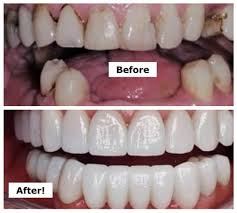 Image result for dental cancer