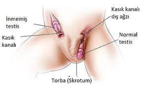 Image result for Undescended Testicle
