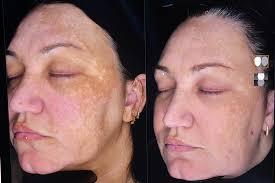 Image result for Melasma