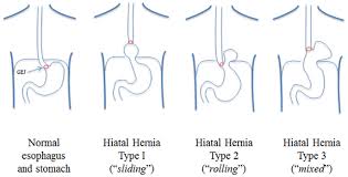 Classification Of Hiatal Hernias Paraesophageal Hernias Are