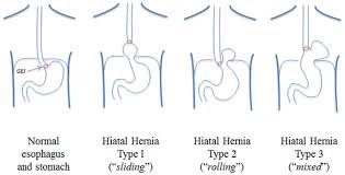 classification of hiatal hernias paraesophageal hernias are