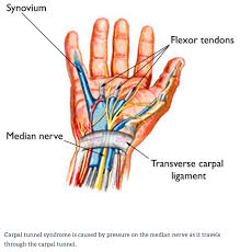 It has never been established. Carpal Tunnel Syndrome Carolyn Yang Md