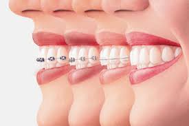 Brackets can be clear or. 4 Types Of Braces To Align Your Teeth Affinity Dental Clinics