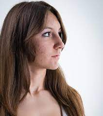 You'll know doxycycline is working for you when you see less acne forming and your skin starts to look clearer. How Does Doxycycline Work For Acne