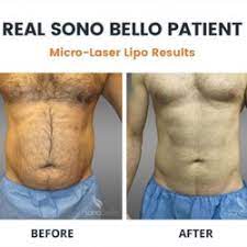 We did not find results for: Sonobello Prices Updated For 2021 Top Liposuction Prices