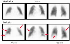 Image result for Ventilation Perfusion Scan