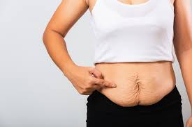 There are so many positives that changed my life that what i gave up doesn't matter, he said. How To Tighten Loose Sagging Skin After Bariatric Surgery Dr Jalil Illan