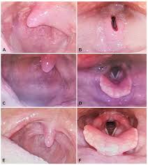 Image result for Angioedema