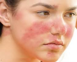WHAT IS ADULT ACNE AND HOW TO TREAT IT? - Dr. Health Clinic