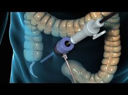 Laparoscopic Appendectomy Surgery Appendicitis Medical Medium Surgery Patient Engagement