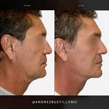 Andres Bustillo, MD, FACS