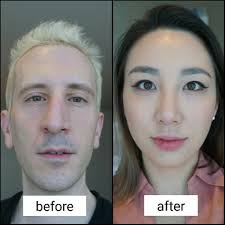 How do they fix a deviated septum. Elky On Twitter Going Into Surgery Now Time For Me To Get That Nose Job I Always Wanted Dr Is Going To Fix My Deviated Septum And Make Me Look