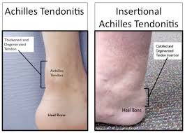 This treatment isn't often used. Mr Peter Ammon Chronic Achilles Tendon Problems Murdoch Orthopaedic Clinic