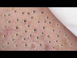 Satisfying Relaxing With Sac Dep Spa Video 183 Youtube In 2021 Blackheads Popping Zit Popping Videos Zits Popping