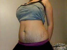 Vicks Vapor Rub For Stretchmarks Babycenter