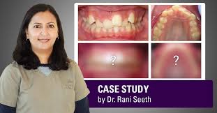 What Do I Do About A Snaggletooth Porcelain Veneer? - Susan M. Dennis, D.D.S