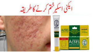 How To Remove Acne Scars Dark Spots Removal Treatments Review In Urdu Youtube